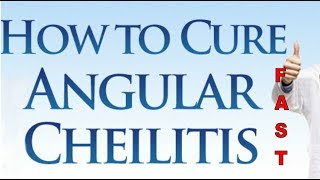 Treatment For Angular Cheilitis How to Treat Angular Stomatitis With Effective Treatment [upl. by Annala]