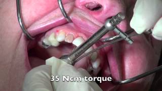 ASC Abutment Removal [upl. by Aharon]