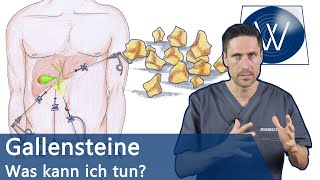 Gallensteine Was nun Typische Symptome Alles zur Entstehung amp Tipps zur natürlichen Entfernung [upl. by Nylle475]