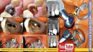 ENDODONTIC Retreatment one curve micromega gutta percha removal rebilda DC [upl. by Ymerej]