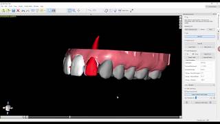 Phase 4  Tooth Alignment [upl. by Icrad]