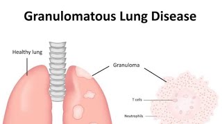 Granulomatous diseases of Lung Introduction [upl. by Cioffred572]