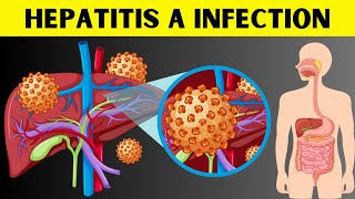 Hepatitis A Infection  Signs amp Symptoms Risk Factors Virology Diagnosis And Treatment [upl. by Ille]