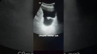 Complex ovarian cyst ultrasonography gynaecology [upl. by Galven]