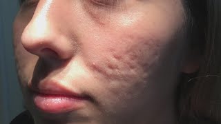 Does This New Procedure Clear up Acne Scars [upl. by Idnac809]