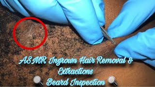 Ingrown Hair Removal amp Extractions Pt 10 🔍 Neck amp Beard Area ASMR Slight Talking [upl. by Pepe]