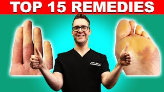 Raynauds Syndrome Top 15 Remedies Symptoms amp Best Treatment [upl. by Lennie]