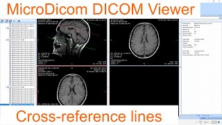 Crossreference lines in MicroDicom [upl. by Wrench]