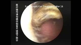 Regular cholesteatoma reexamination and cleaning of the ear [upl. by Nester214]