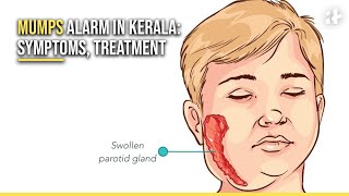 Kerala Mumps Outbreak What Are The Causes Symptoms And Treatment [upl. by Alpheus]