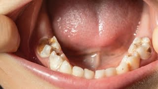 Dental Cavities Explained Causes Symptoms and Treatments You Need to Know [upl. by Nereen]