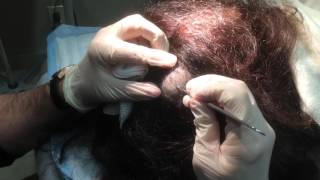 Pilar Cyst Removal on the Scalp [upl. by Foskett]