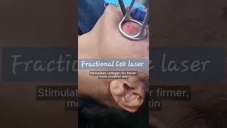 CO2 fractional laser✨ co2laser skintreatment skincare shortsfeed [upl. by Nagek]