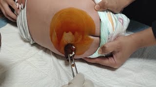 How to perform a lumbar puncture Lumbar puncture in the emergency department setting [upl. by Eimirej967]