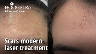 Scars modern laser treatment  23249 [upl. by Tnomel766]