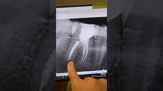 Root canal therapy of tooth 30 [upl. by Bautista434]