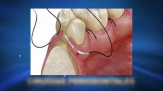 La Periodoncia un efectivo tratamiento guiado por los dentistas en Madrid [upl. by Ellen]