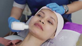 What is HIFU treatment  Instant Facelift without surgery [upl. by Audres240]