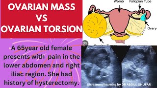 Ovarian cancer ultrasound  ovarian tumour ultrasound  ovarian torsion usg ovarian cancer symptoms [upl. by Denver196]