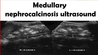 Medullary nephrocalcinosis Ultrasound [upl. by Yevi]