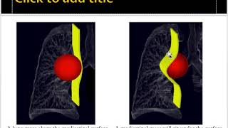 Chest xray Superior mediastinal structures [upl. by Ursala]