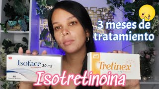 3 meses de tratamiento usando isotretinoina [upl. by Tiossem]