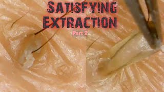 Blackhead  Whiteheads Extraction using tweezer part 2 [upl. by Acinahs]