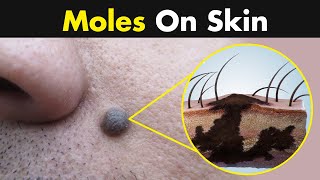 What Causes Moles in our skin 3D Animation [upl. by Adnilym]