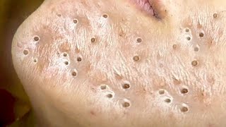 Big Cystic Acne Blackheads Extraction Blackheads amp Milia Whiteheads Removal Pimple Popping  8387 [upl. by Seafowl]