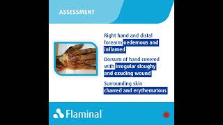 Case Report  Flaminal® Forte in the recovery from Severe Burns [upl. by Arocat]