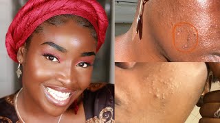 I RUINED MY SKIN  How I used Differin and Tetralysal to clear my skin again [upl. by Regdirb]