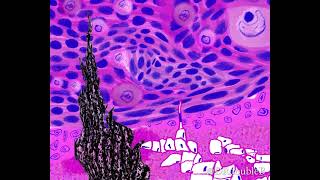 Starry NightBurkitts lymphoma animated Van Gogh pathology art [upl. by Nannerb]