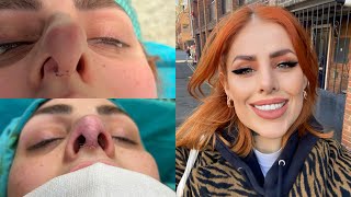 I got SeptoRhinoplasty in Turkey VLOG amp QampA [upl. by Ailhat]