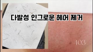 다발성 인그로운 헤어 제거 왁싱 후 생긴 부작용 [upl. by Gonick]