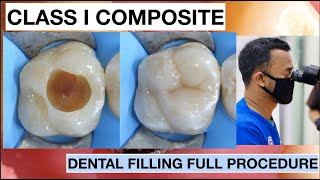 Dental Filling Full Procedure Class I Composite  General Dentist Griya RR [upl. by Elleirda]