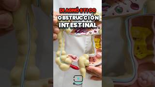 ¿intestino irritable u obstrucción intestinal  doctor jovel cirujano [upl. by Aala]