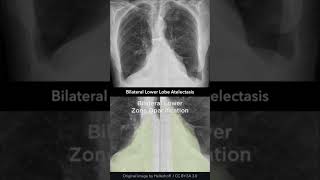 Bilateral Lower Lobe Atelectasis Chest Xray shorts [upl. by Mollie]