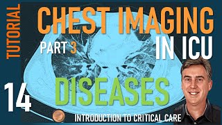 Chest Imaging in ICU  Part 3  Diseases of the Lung in ICU [upl. by Ttocserp]