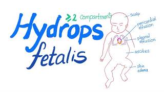 Hydrops fetalis [upl. by Philoo889]