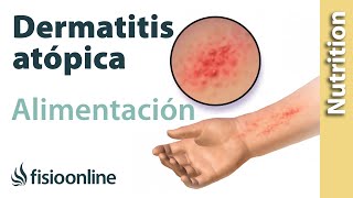 Importancia de la nutrición en el desarrollo en la dermatitis atópica [upl. by Rosinski532]