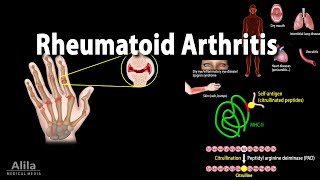 Rheumatoid Arthritis Animation [upl. by Helve825]