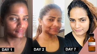 25 TCA Chemical Peel at home method and progress by Hina UrduHindi [upl. by Ruthann]