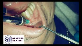 Infiltration anesthesia for treatment 3334 tooth [upl. by Annaiel]