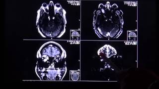 thyroid opthalmopathy in T2 and STIR mri sequence by Radiologie TV [upl. by Franek]