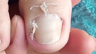 Toenail corners are curved and painful gently  part 64NhaNguyenPhanThiet [upl. by Figge559]