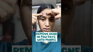 Pimples removal on face at home no side effects acne short shortsfeed shortvideoviral [upl. by Noied726]