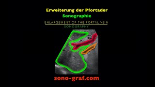 Sonographie  Erweiterung der Pfortader [upl. by Meilen]