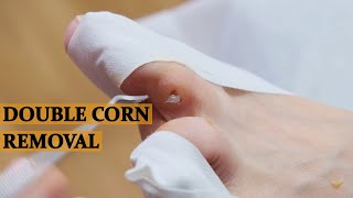 DEEP SATISFYING CORN REMOVAL [upl. by Eisoj752]