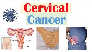 Cervical Cancer Risk Factors Pathophysiology Symptoms Staging Diagnosis Treatment amp Prevention [upl. by Eimot682]