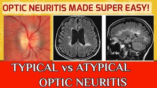 OPTIC NEURITIS  Typical optic neuritis and atypical optic neuritis [upl. by Aeiram]